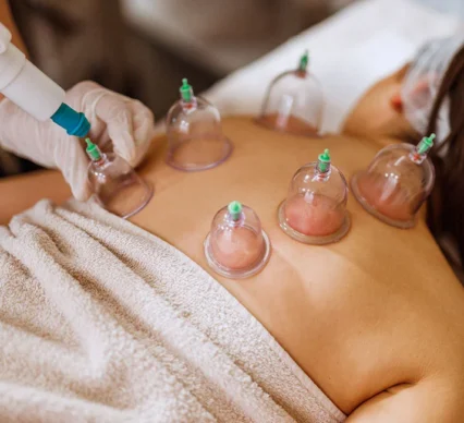 16554-cupping-therapy